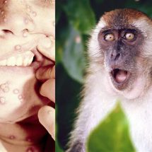 دراسة "صادمة".. متى بدأ انتشار فيروس "جدري القرود" في العالم؟