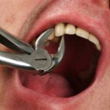 عامل نظافة ينتحل صفة طبيب ويقلع 4 أسنان من مريض