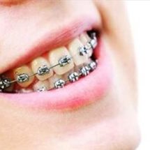 هل يؤثر تقويم الأسنان على الدماغ؟.. دراسة توضح